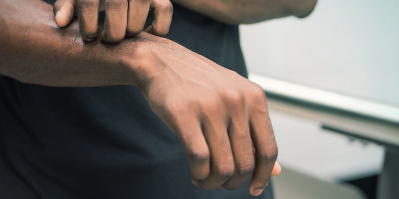 Sintomas de alergia ao cannabis