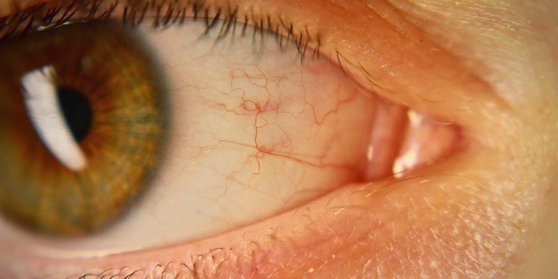 Olhos vermelhos ou injetados